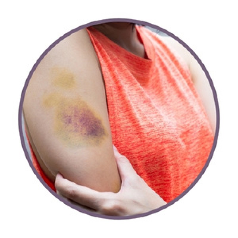 Pomadas para hematomas
